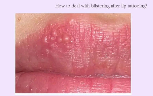 What if the lips have blisters due to the herpes virus?