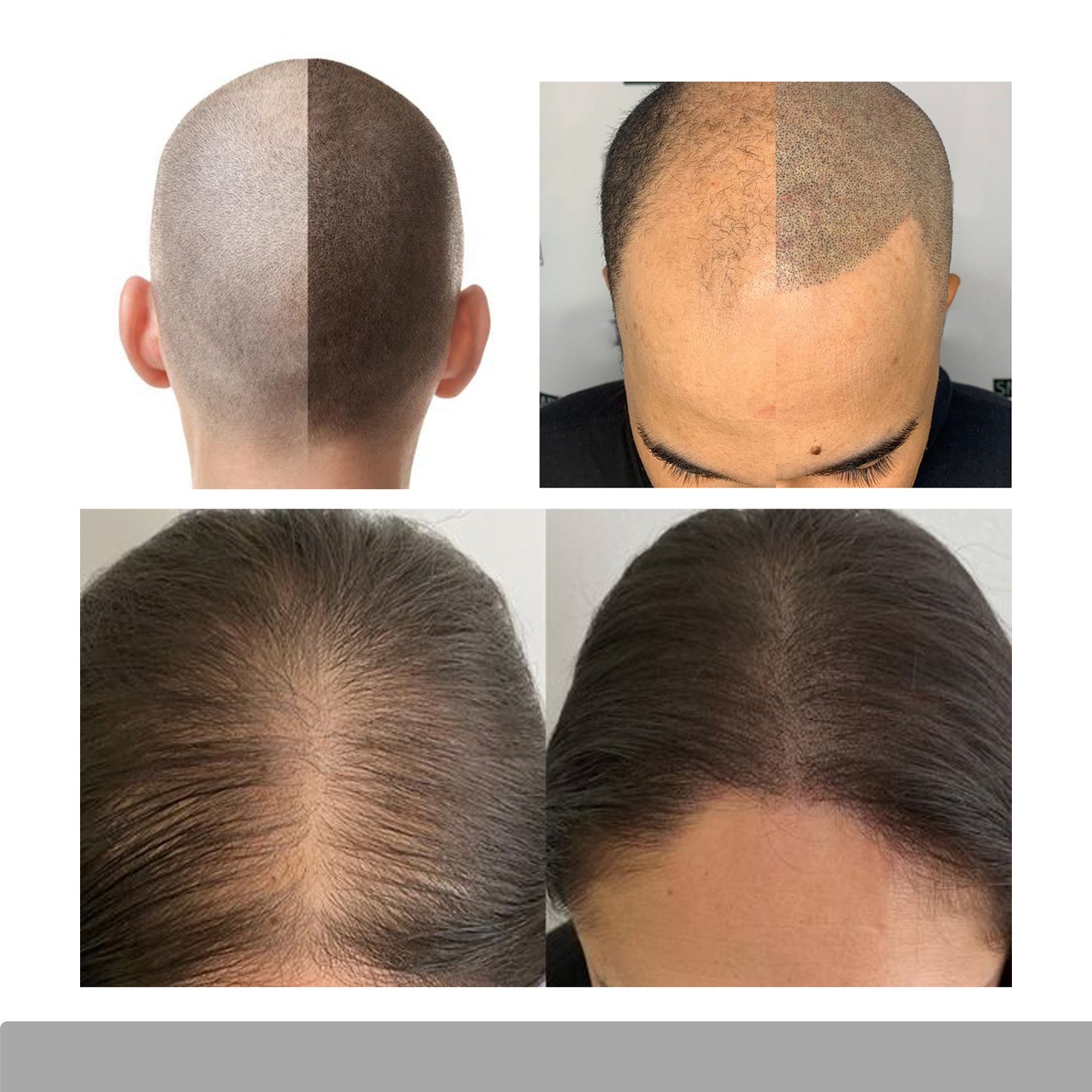 FAMISOO 5ML SMP Scalp Pigments – 4 Shades for Natural Hairline Restoration