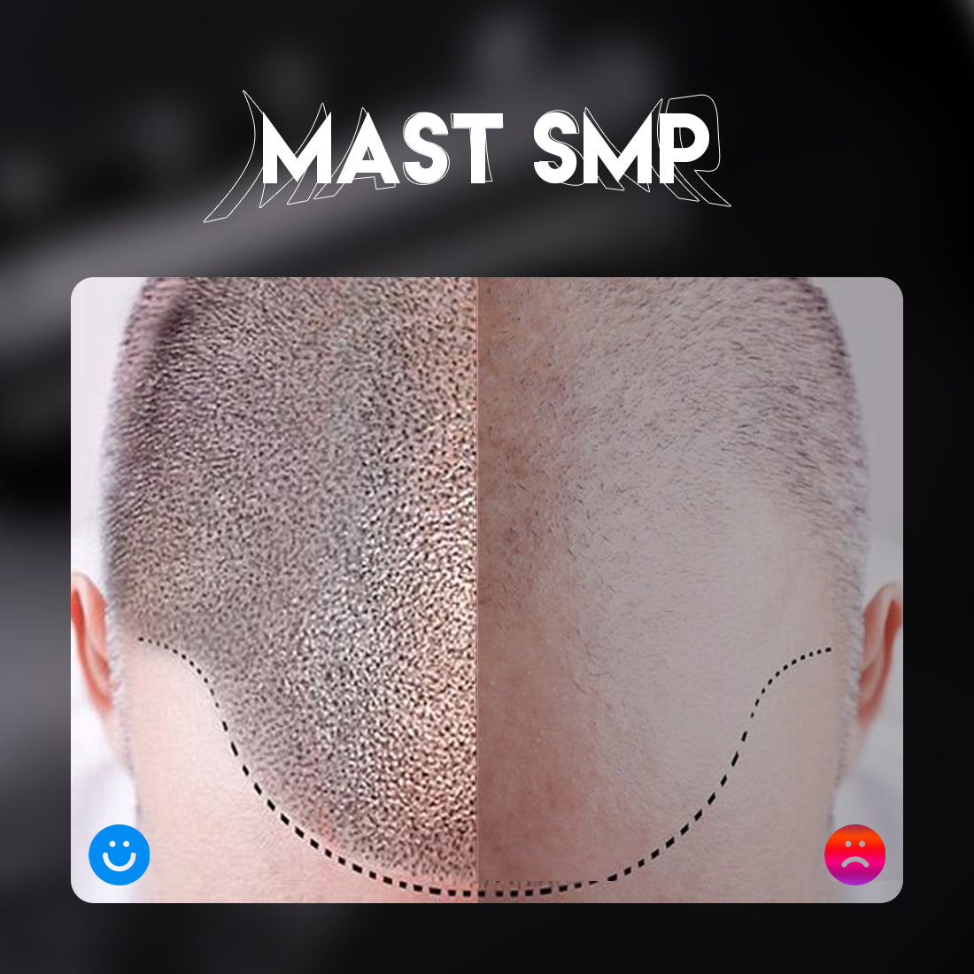 Mast SMP Set Scalp Micropigmentation Bundle WQ620 - Free Shipping