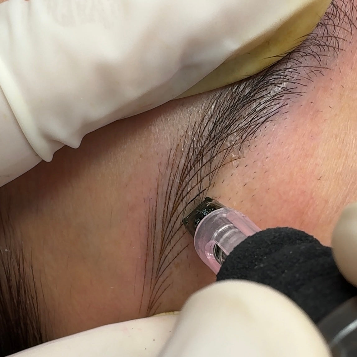 XF Upgrade XU14 Special PMU Needle - 10PCS/Box (For Use Only with XF Machines – Not Compatible with Other Devices)