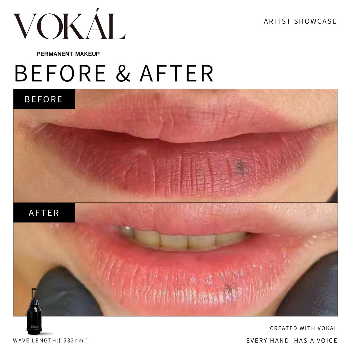 VOKAL LASER 2.0 Professional Pigment Removal Laser System – Multi-Wavelength PMU & Tattoo Removal Machine