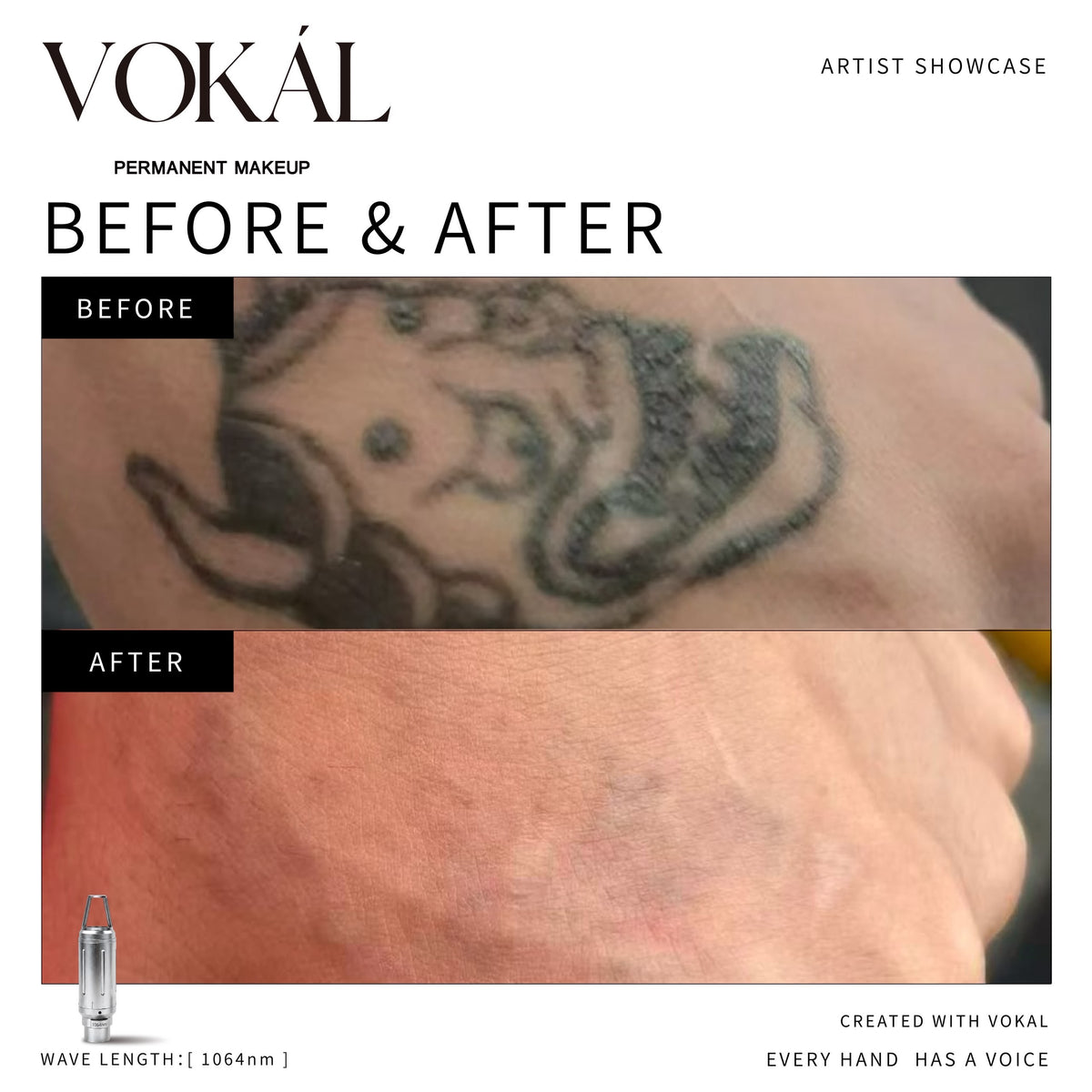 VOKAL LASER 2.0 Professional Pigment Removal Laser System – Multi-Wavelength PMU & Tattoo Removal Machine