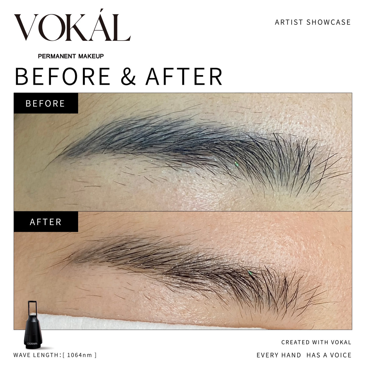 VOKAL LASER 2.0 Professional Pigment Removal Laser System – Multi-Wavelength PMU & Tattoo Removal Machine