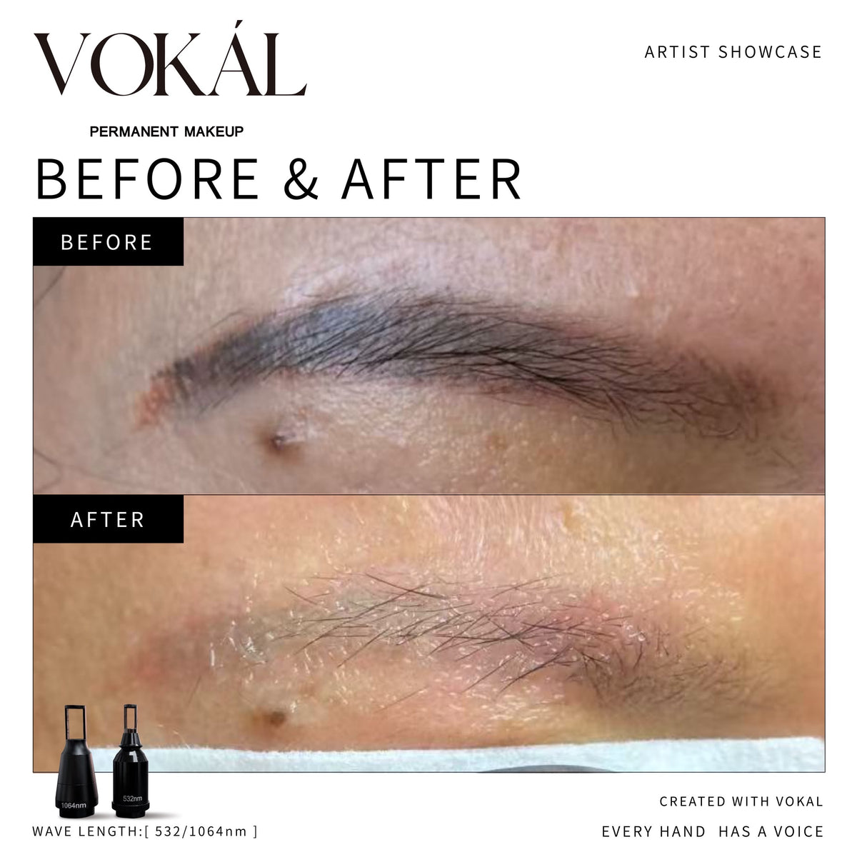 VOKAL LASER 2.0 Professional Pigment Removal Laser System – Multi-Wavelength PMU & Tattoo Removal Machine