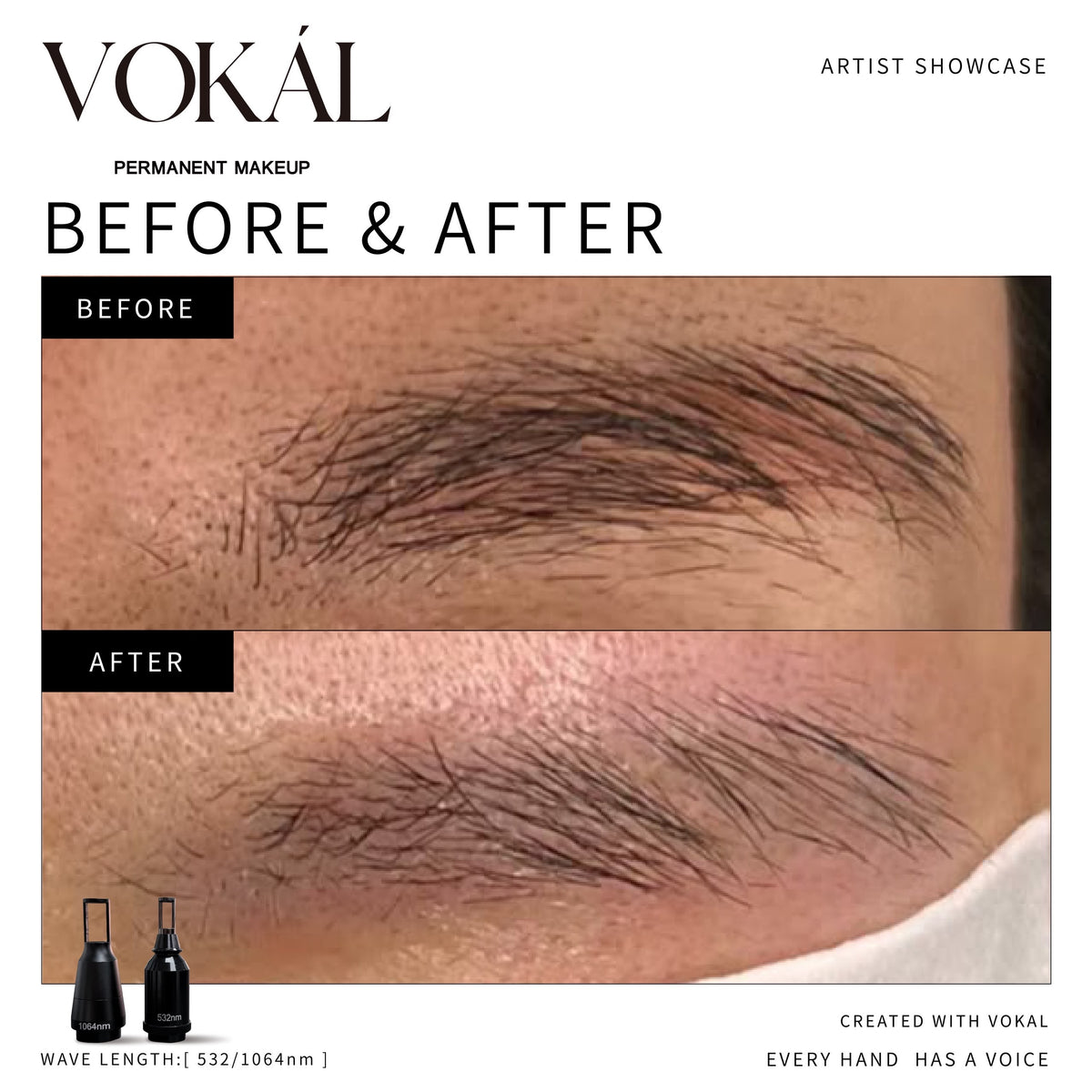 VOKAL LASER 2.0 Professional Pigment Removal Laser System – Multi-Wavelength PMU & Tattoo Removal Machine