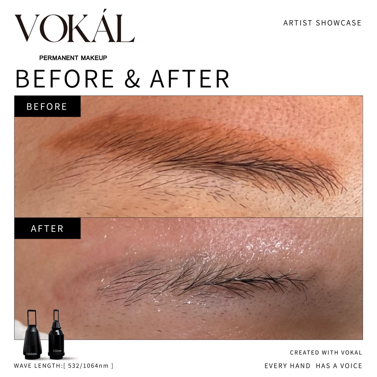 VOKAL LASER 2.0 Professional Pigment Removal Laser System – Multi-Wavelength PMU & Tattoo Removal Machine