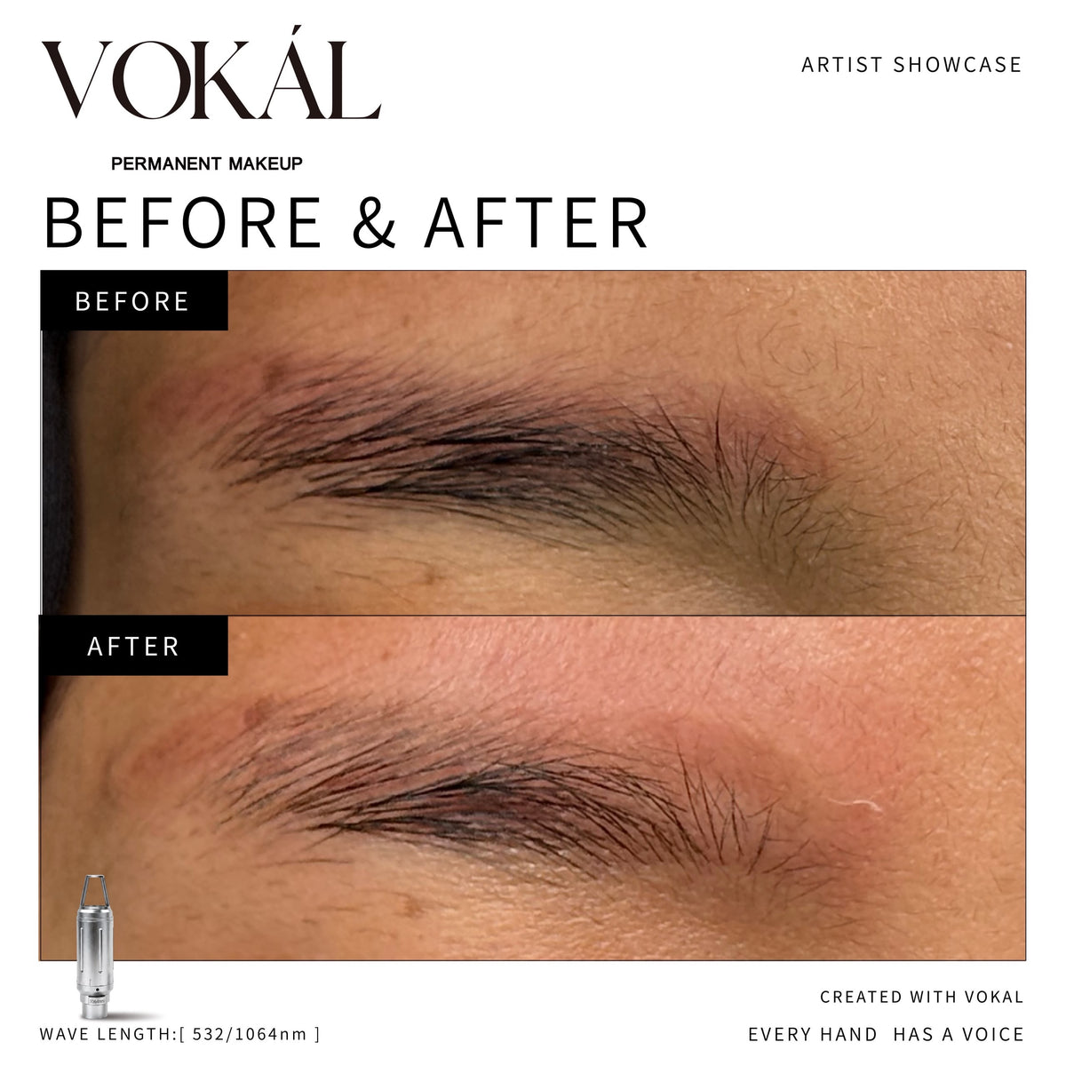VOKAL LASER 2.0 Professional Pigment Removal Laser System – Multi-Wavelength PMU & Tattoo Removal Machine