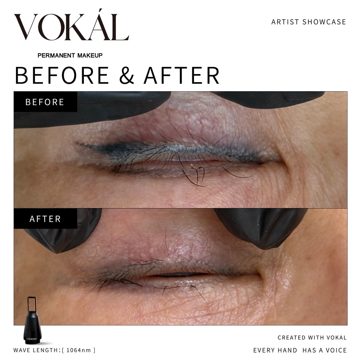 VOKAL LASER 2.0 Professional Pigment Removal Laser System – Multi-Wavelength PMU & Tattoo Removal Machine