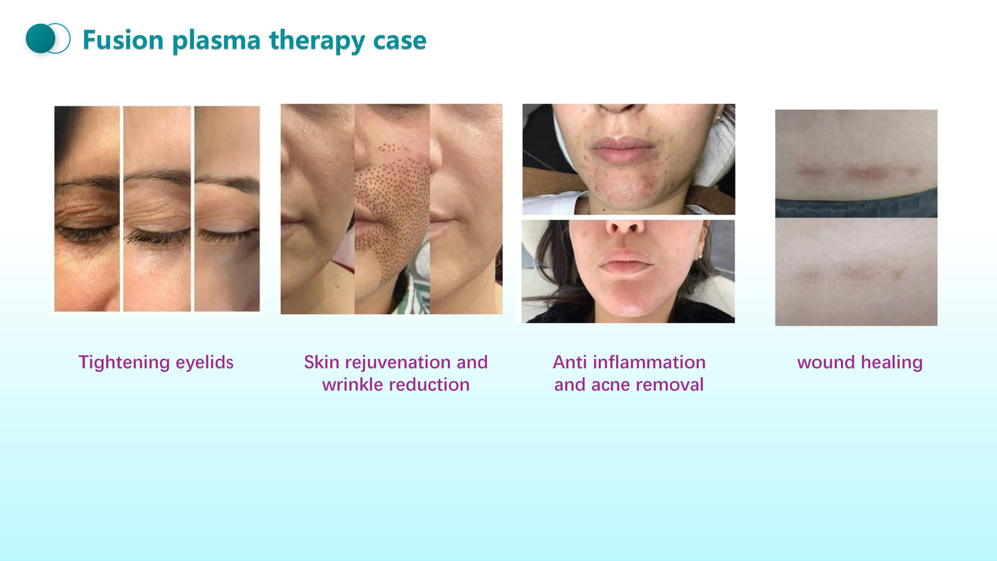 Fusion Plasma Machine – Cold & Hot Plasma Technology for Advanced Skin and Scalp Regeneration