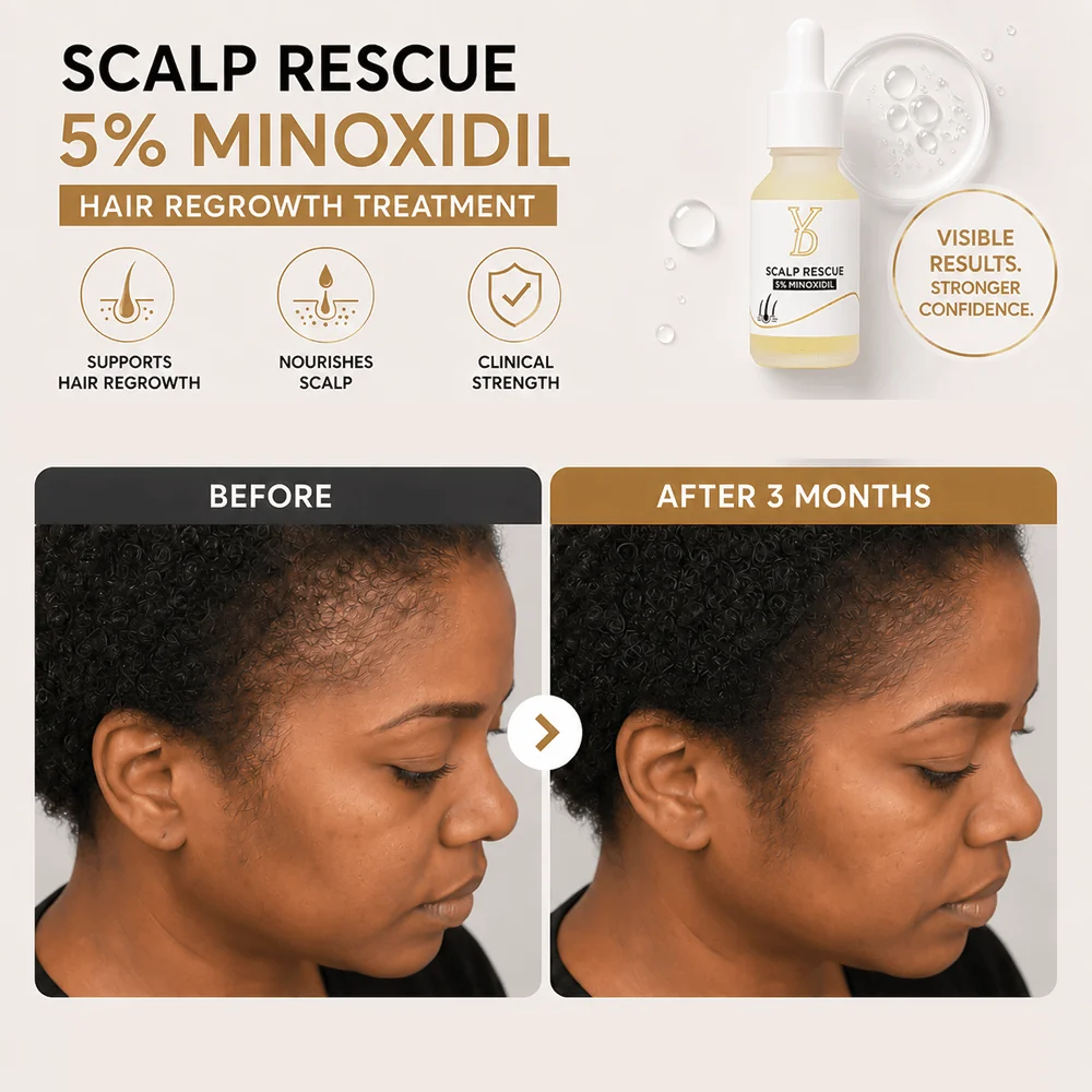 YD Scalp Rescue 5% Minoxidil Hair Regrowth Treatment – 15ml